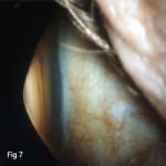 Keratoconus