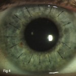 deterioration of vision