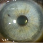 lamellar keratoplasty